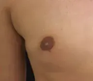 Skin Lesion after