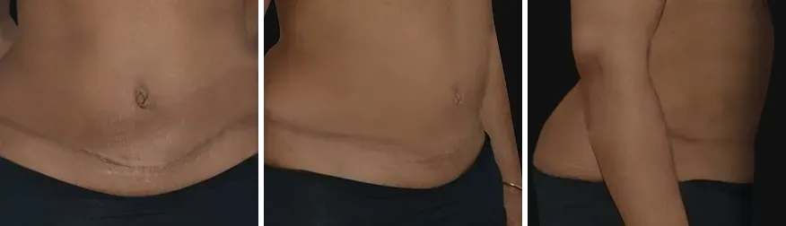 Tummy Tuck after