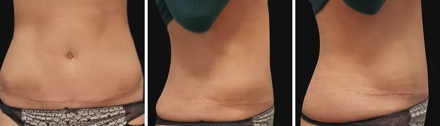 Tummy Tuck after