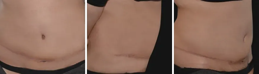 Tummy Tuck after
