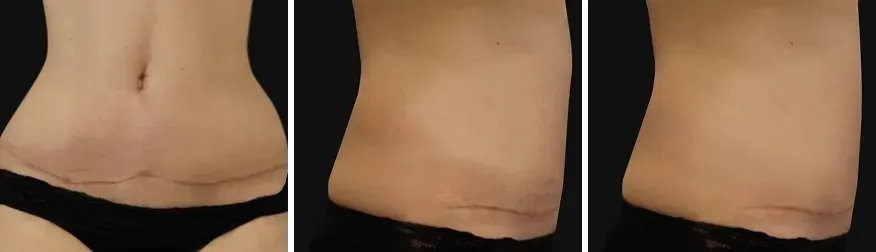 Tummy Tuck after