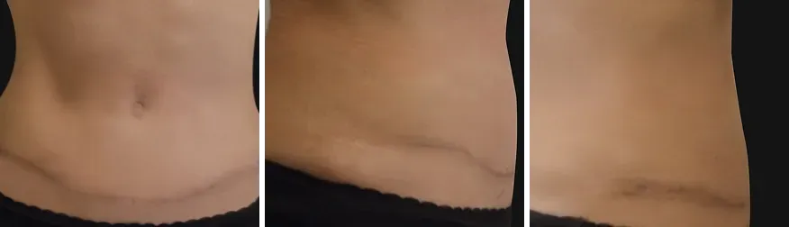 Tummy Tuck after