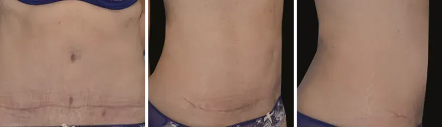Tummy Tuck after