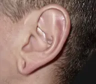 Earlobe Repair before