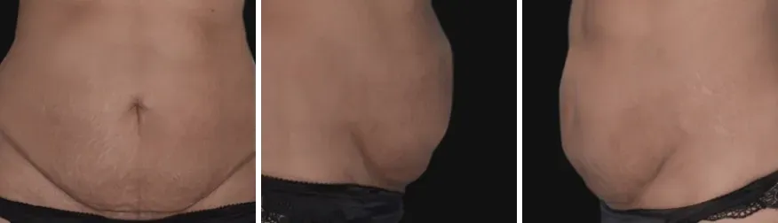 Tummy Tuck before