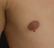 Skin Lesion before