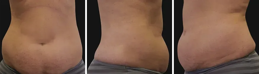 Tummy Tuck before