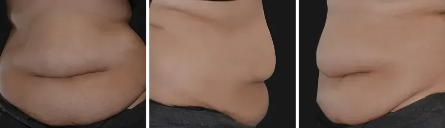 Tummy Tuck before