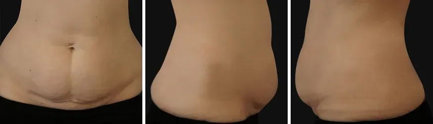 Tummy Tuck before