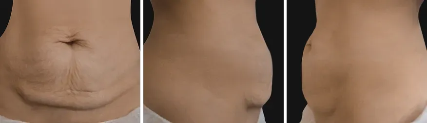 Tummy Tuck before