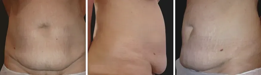 Tummy Tuck before